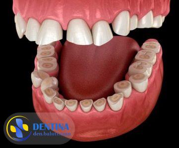 دندان قروچه و راه های درمان آن را بشناسید!