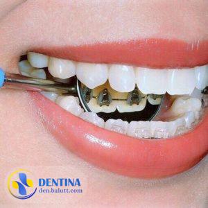 ارتودنسی لینگوال یا پشت دندانی را به طور کامل بشناسید!